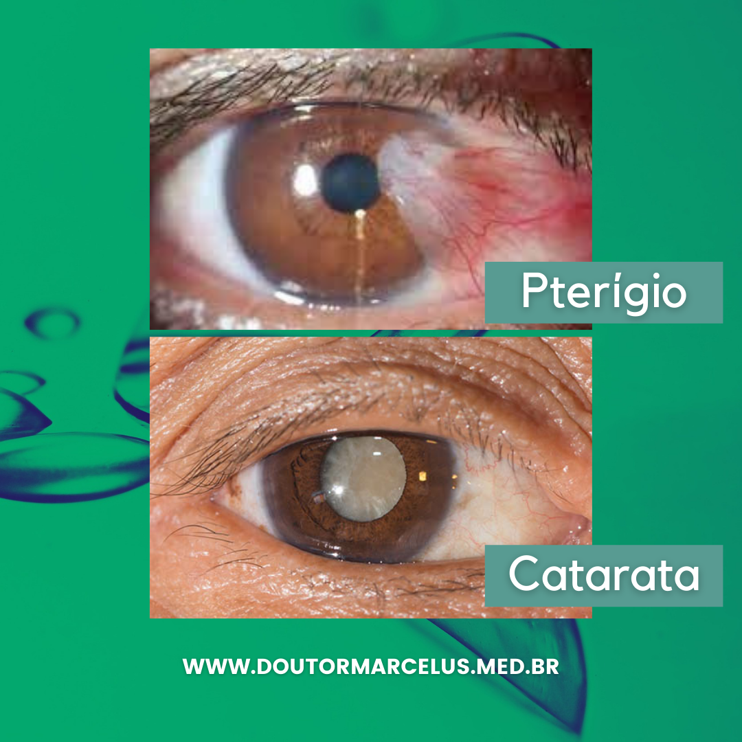Piterigeno VOCÊ SABE A DIFERENÇA ENTRE PTERÍGIO E CATARATA? – Doutor Marcelus Layguel