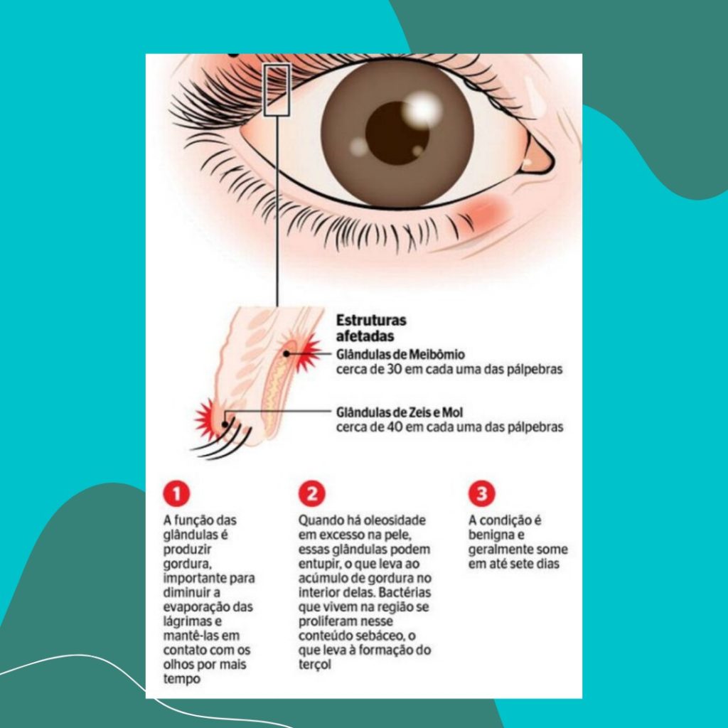 EyeKids  Terçol, hordéolo e calázio: qual a diferença, por que aparecem e  como tratar