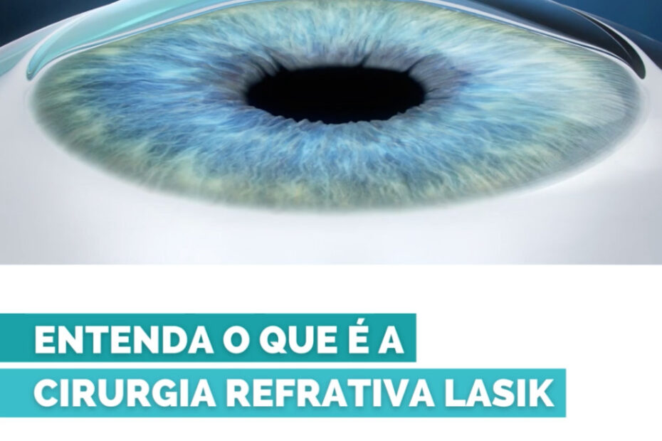 CIRURGIA REFRATIVA À LASER LASIK Doutor Marcelus Layguel